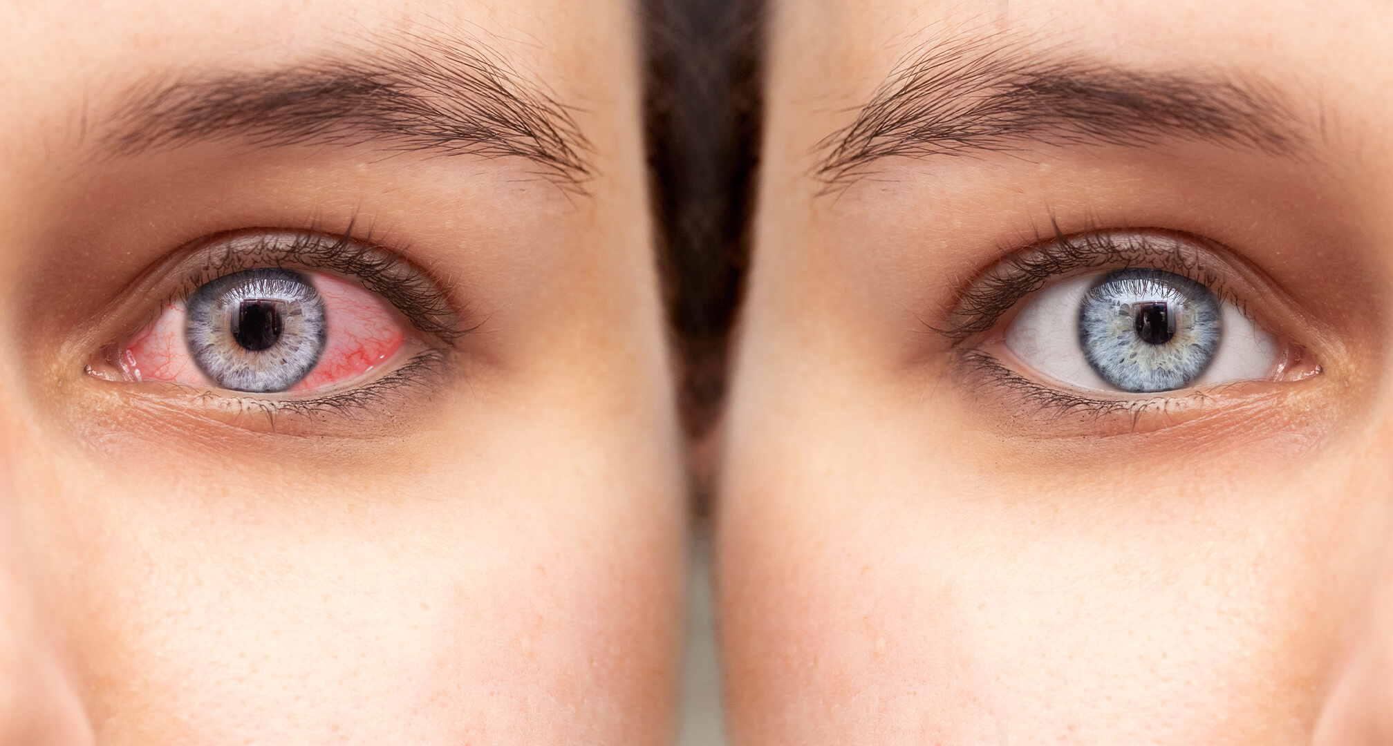 detailný záber dvoch očí vedľa seba, červené suché oko vľavo a zdravé oko vpravo.